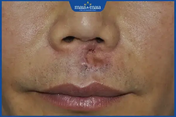 Tìm Hiểu Tướng Râu Không Mọc Ở Nhân Trung: Nguyên Nhân Và Cách Khắc Phục Cho Nam Giới