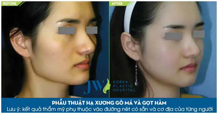 Tướng Số Khi Hạ Gò Má: Ý Nghĩa Phong Thủy Và Thay Đổi Nhân Tướng Sau Thẩm Mỹ Tướng Số Khi Hạ Gò Má: Ý Nghĩa Phong Thủy Và Thay Đổi Nhân Tướng Sau Thẩm Mỹ