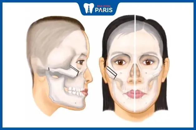 Tướng Số Khi Hạ Gò Má: Ý Nghĩa Phong Thủy Và Thay Đổi Nhân Tướng Sau Thẩm Mỹ Tướng Số Khi Hạ Gò Má: Ý Nghĩa Phong Thủy Và Thay Đổi Nhân Tướng Sau Thẩm Mỹ