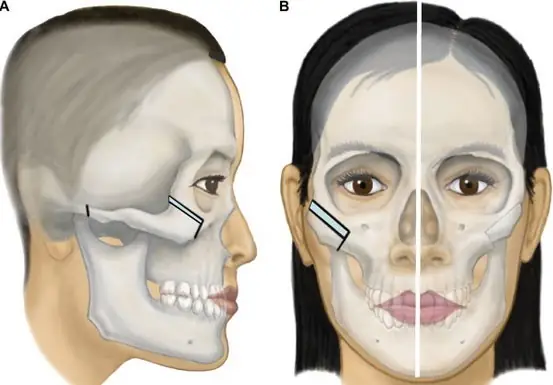 Tướng Số Khi Hạ Gò Má: Ý Nghĩa Phong Thủy Và Thay Đổi Nhân Tướng Sau Thẩm Mỹ Tướng Số Khi Hạ Gò Má: Ý Nghĩa Phong Thủy Và Thay Đổi Nhân Tướng Sau Thẩm Mỹ