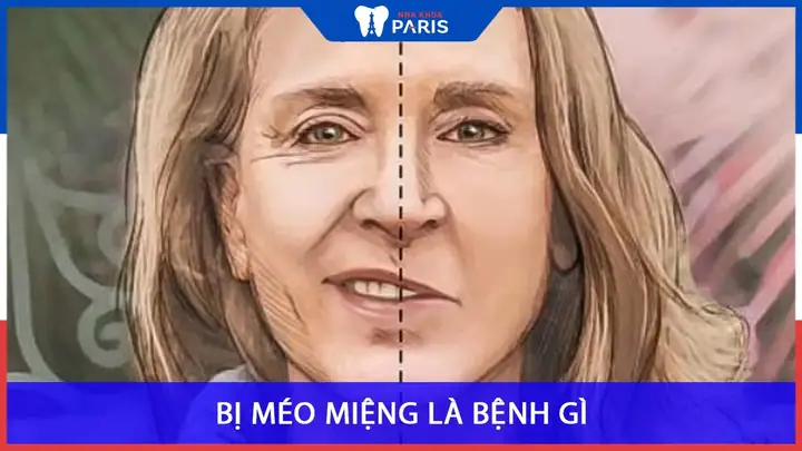 Giải Nghĩa Tướng Số Miệng Méo Bên Trái Và Ý Nghĩa Vận Mệnh, Tính Cách Người Sở Hữu Giải Nghĩa Tướng Số Miệng Méo Bên Trái Và Ý Nghĩa Vận Mệnh, Tính Cách Người Sở Hữu