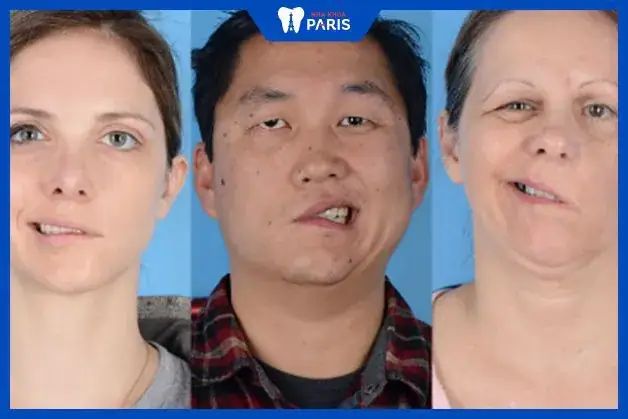 Giải Nghĩa Tướng Số Miệng Méo Bên Trái Và Ý Nghĩa Vận Mệnh, Tính Cách Người Sở Hữu Giải Nghĩa Tướng Số Miệng Méo Bên Trái Và Ý Nghĩa Vận Mệnh, Tính Cách Người Sở Hữu