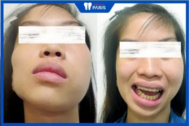Giải Nghĩa Tướng Số Miệng Méo Bên Trái Và Ý Nghĩa Vận Mệnh, Tính Cách Người Sở Hữu Giải Nghĩa Tướng Số Miệng Méo Bên Trái Và Ý Nghĩa Vận Mệnh, Tính Cách Người Sở Hữu