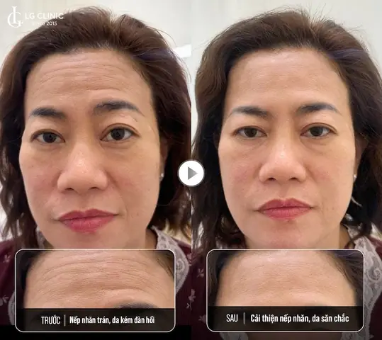 Giải Mã Tướng Số Nếp Nhăn Trên Trán Theo Nhân Tướng Học Cho Người Muốn Xem Vận Mệnh Giải Mã Tướng Số Nếp Nhăn Trên Trán Theo Nhân Tướng Học Cho Người Muốn Xem Vận Mệnh