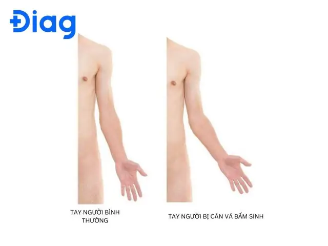 Hướng Dẫn Xem Tướng Tay Cán, Cánh Tay Và Bàn Tay: Dấu Hiệu Phú Quý, Phúc Lộc Và Nhân Cách