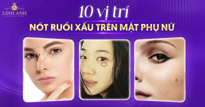 Tổng Hợp Các Vị Trí Nốt Ruồi Không Tốt Trên Mặt Phụ Nữ Theo Nhân Tướng Học