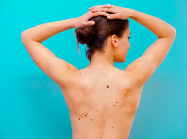 Giải Mã Ý Nghĩa Nốt Ruồi Sau Lưng Theo Nhân Tướng Học Cho Nam Và Nữ