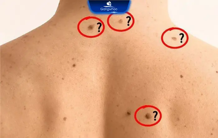 Giải Mã Ý Nghĩa Nốt Ruồi Sau Lưng Theo Nhân Tướng Học Cho Nam Và Nữ