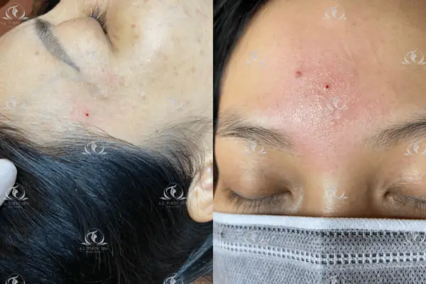 Tổng Hợp Vị Trí Nốt Ruồi Son May Mắn Trên Cơ Thể Theo Nhân Tướng Học