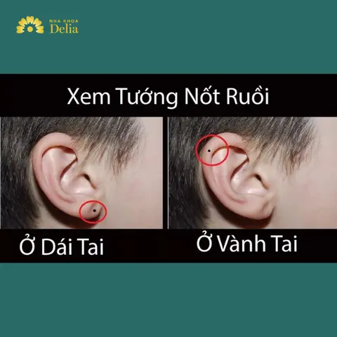 Giải Mã Ý Nghĩa Nốt Ruồi Trên Tai Theo Nhân Tướng Học Cho Nam Và Nữ