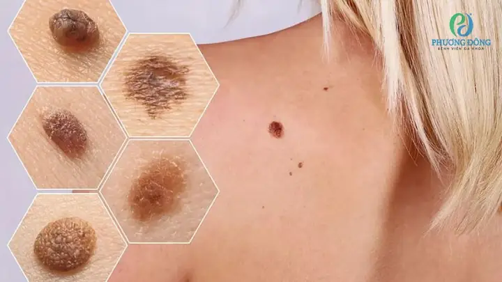Nhận Biết Vị Trí Nốt Ruồi Ung Thư Trên Cơ Thể Và Dấu Hiệu Cảnh Báo Theo Nguyên Tắc Abcde