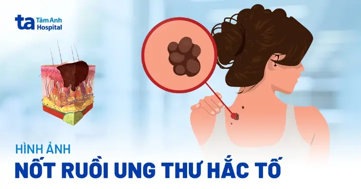 Nhận Biết Vị Trí Nốt Ruồi Ung Thư Trên Cơ Thể Và Dấu Hiệu Cảnh Báo Theo Nguyên Tắc Abcde