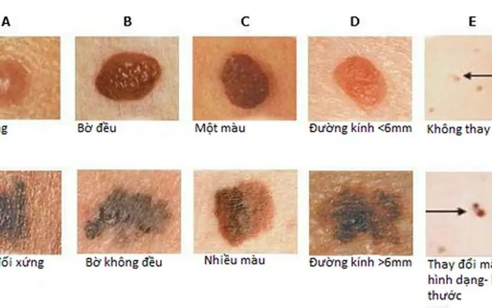 Nhận Biết Vị Trí Nốt Ruồi Ung Thư Trên Cơ Thể Và Dấu Hiệu Cảnh Báo Theo Nguyên Tắc Abcde
