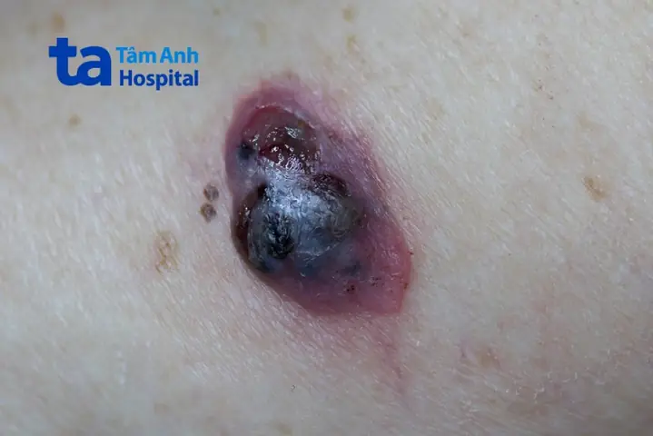 Nhận Biết Vị Trí Nốt Ruồi Ung Thư Trên Cơ Thể Và Dấu Hiệu Cảnh Báo Theo Nguyên Tắc Abcde