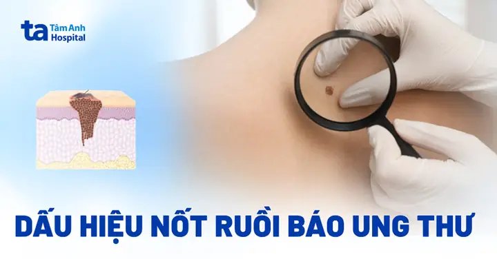 Nhận Biết Vị Trí Nốt Ruồi Ung Thư Trên Cơ Thể Và Dấu Hiệu Cảnh Báo Theo Nguyên Tắc Abcde
