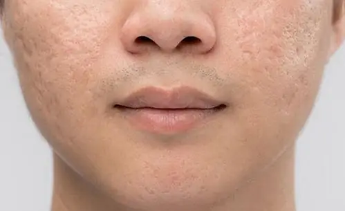 Xem Tướng Đàn Ông Mặt Rỗ: Ý Nghĩa Vận Mệnh Theo Nhân Tướng Học Xem Tướng Đàn Ông Mặt Rỗ: Ý Nghĩa Vận Mệnh Theo Nhân Tướng Học
