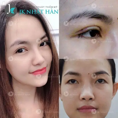 Giải Nghĩa Tướng Mắt Nhiều Mí: Vận Mệnh, Tính Cách Và Cách Khắc Phục Cho Người Sở Hữu Giải Nghĩa Tướng Mắt Nhiều Mí: Vận Mệnh, Tính Cách Và Cách Khắc Phục Cho Người Sở Hữu
