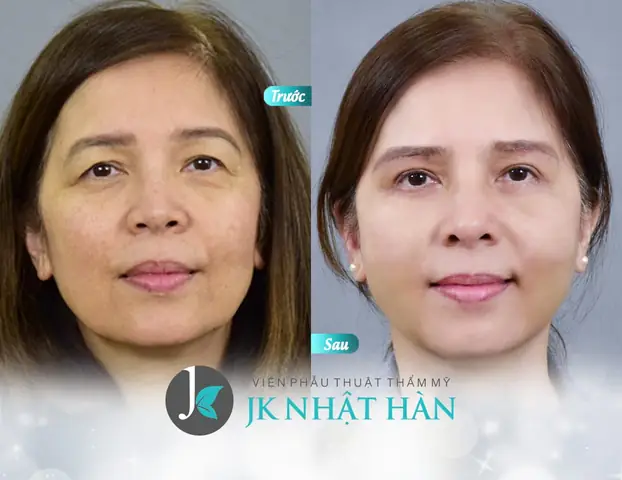 Giải Nghĩa Tướng Mắt Nhiều Mí: Vận Mệnh, Tính Cách Và Cách Khắc Phục Cho Người Sở Hữu Giải Nghĩa Tướng Mắt Nhiều Mí: Vận Mệnh, Tính Cách Và Cách Khắc Phục Cho Người Sở Hữu