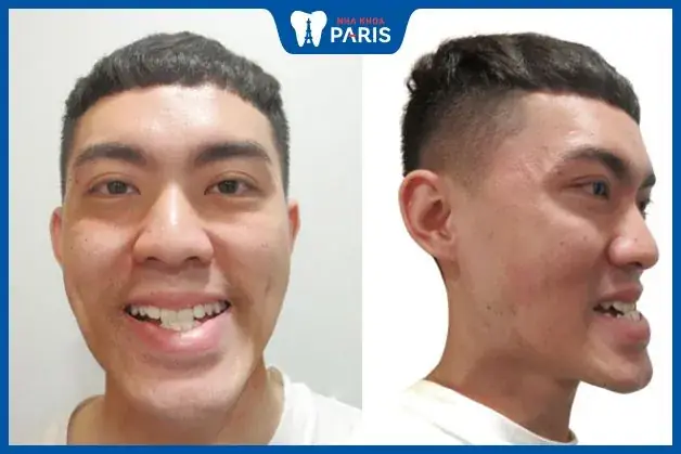 Xem Tướng Miệng Móm: Tướng Số, Tính Cách Nam Nữ, Xấu Hay Đẹp & Cách Khắc Phục Hiệu Quả Xem Tướng Miệng Móm: Tướng Số, Tính Cách Nam Nữ, Xấu Hay Đẹp & Cách Khắc Phục Hiệu Quả