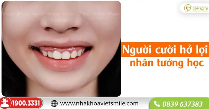 Xem Tướng Người Cười Hở Lợi: Sướng Hay Khổ Theo Nhân Tướng Học? Xem Tướng Người Cười Hở Lợi: Sướng Hay Khổ Theo Nhân Tướng Học?