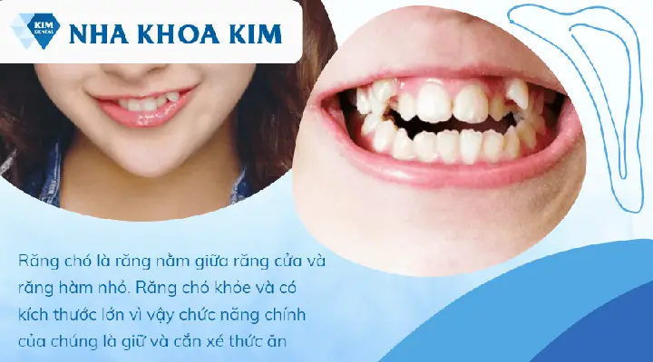 Xem Tướng Răng Chó (răng Nanh): Ý Nghĩa Nhân Tướng, Tính Cách, Vận Mệnh & Cách Khắc Phục Y Khoa Xem Tướng Răng Chó (răng Nanh): Ý Nghĩa Nhân Tướng, Tính Cách, Vận Mệnh & Cách Khắc Phục Y Khoa