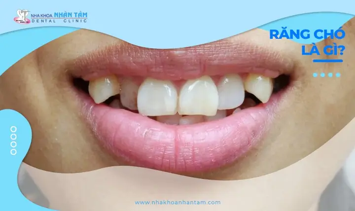 Xem Tướng Răng Chó (răng Nanh): Ý Nghĩa Nhân Tướng, Tính Cách, Vận Mệnh & Cách Khắc Phục Y Khoa Xem Tướng Răng Chó (răng Nanh): Ý Nghĩa Nhân Tướng, Tính Cách, Vận Mệnh & Cách Khắc Phục Y Khoa