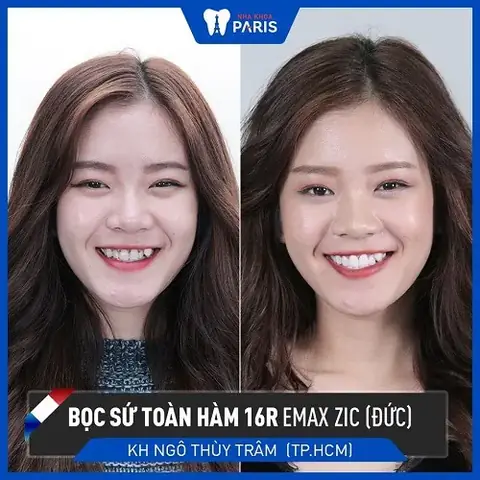 Xem Tướng Răng Hổ: Ý Nghĩa, Tốt Xấu, Vận Mệnh Nam/nữ & Cách Khắc Phục Hiệu Quả Xem Tướng Răng Hổ: Ý Nghĩa, Tốt Xấu, Vận Mệnh Nam/nữ & Cách Khắc Phục Hiệu Quả