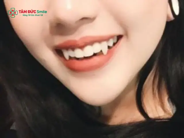 Xem Tướng Răng Hổ: Ý Nghĩa, Tốt Xấu, Vận Mệnh Nam/nữ & Cách Khắc Phục Hiệu Quả Xem Tướng Răng Hổ: Ý Nghĩa, Tốt Xấu, Vận Mệnh Nam/nữ & Cách Khắc Phục Hiệu Quả