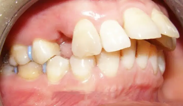 Xem Tướng Răng Hổ: Ý Nghĩa, Tốt Xấu, Vận Mệnh Nam/nữ & Cách Khắc Phục Hiệu Quả Xem Tướng Răng Hổ: Ý Nghĩa, Tốt Xấu, Vận Mệnh Nam/nữ & Cách Khắc Phục Hiệu Quả