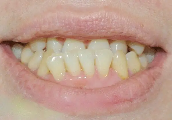 Xem Tướng Răng Quặp: Luận Giải Ý Nghĩa Số Mệnh, Tính Cách Nam Nữ Chi Tiết