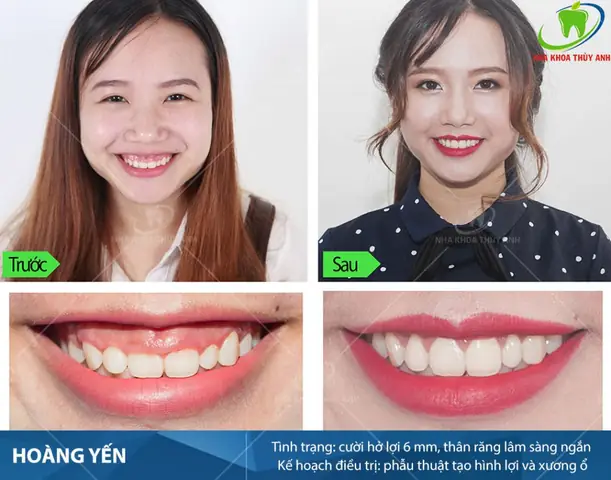 Giải Mã Tướng Số Phụ Nữ Cười Hở Lợi: Tốt Hay Xấu Theo Nhân Tướng Học