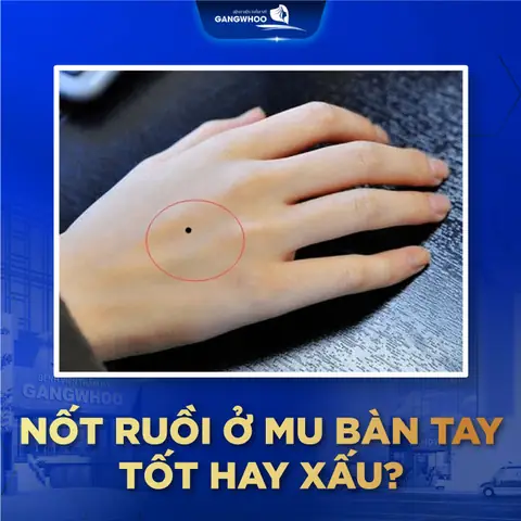 Giải Mã Ý Nghĩa Vị Trí Nốt Ruồi Trên Bàn Tay Theo Nhân Tướng Học Giải Mã Ý Nghĩa Vị Trí Nốt Ruồi Trên Bàn Tay Theo Nhân Tướng Học