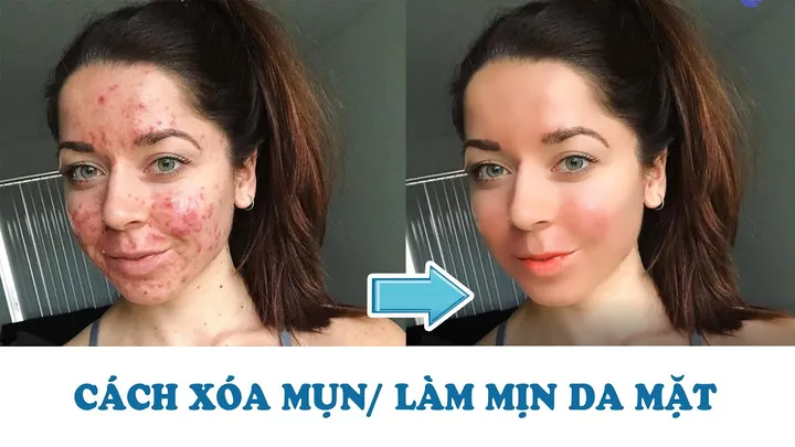 100+ Ảnh Con Gái Mặt Mụn Trước Sau Photoshop Cực Sốc, Đẹp Nhất