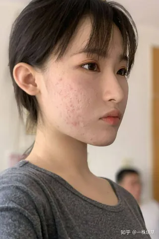 100+ Ảnh Con Gái Mặt Mụn Trước Sau Photoshop Cực Sốc, Đẹp Nhất