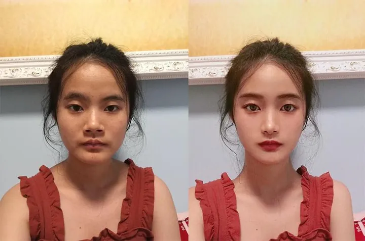 100+ Ảnh Con Gái Mặt Mụn Trước Sau Photoshop Cực Sốc, Đẹp Nhất