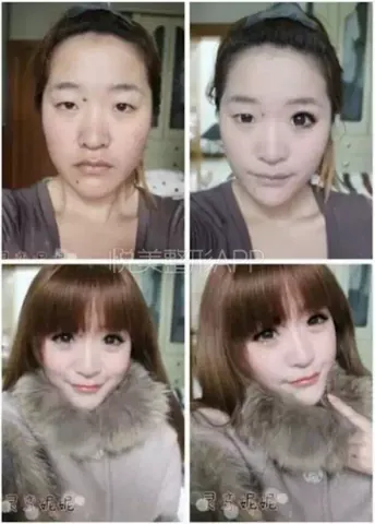 100+ Ảnh Con Gái Mặt Mụn Trước Sau Photoshop Cực Sốc, Đẹp Nhất