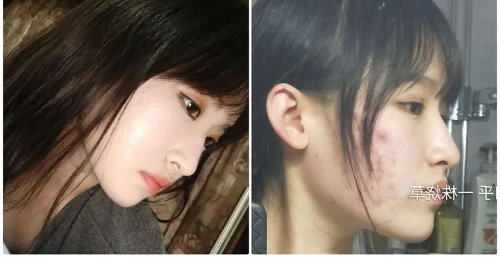 100+ Ảnh Con Gái Mặt Mụn Trước Sau Photoshop Cực Sốc, Đẹp Nhất