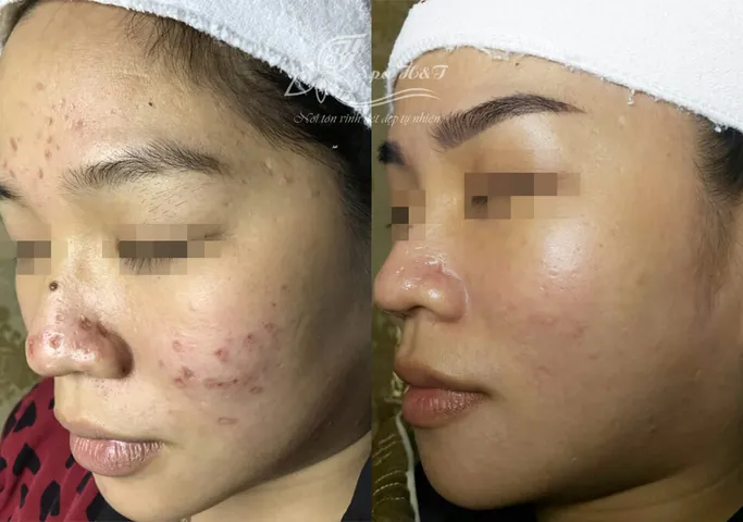 100+ Ảnh Con Gái Mặt Mụn Trước Sau Photoshop Cực Sốc, Đẹp Nhất