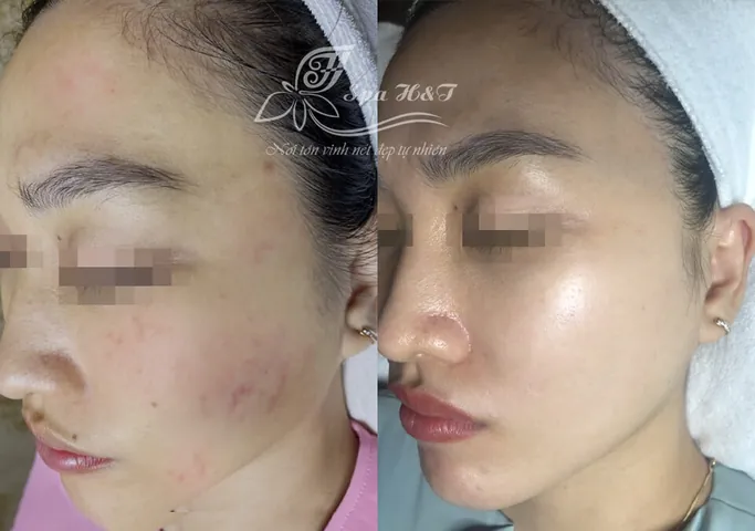 100+ Ảnh Con Gái Mặt Mụn Trước Sau Photoshop Cực Sốc, Đẹp Nhất