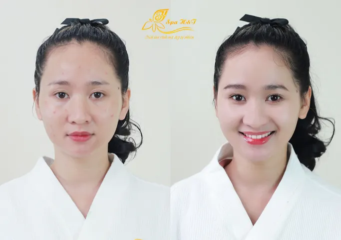 100+ Ảnh Con Gái Mặt Mụn Trước Sau Photoshop Cực Sốc, Đẹp Nhất