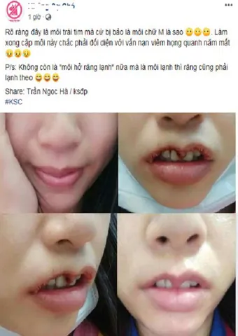 100+ Hình Ảnh Cô Gái Môi Trái Tim 4k, Ảnh Gái Xinh Môi Tim Cực Chất