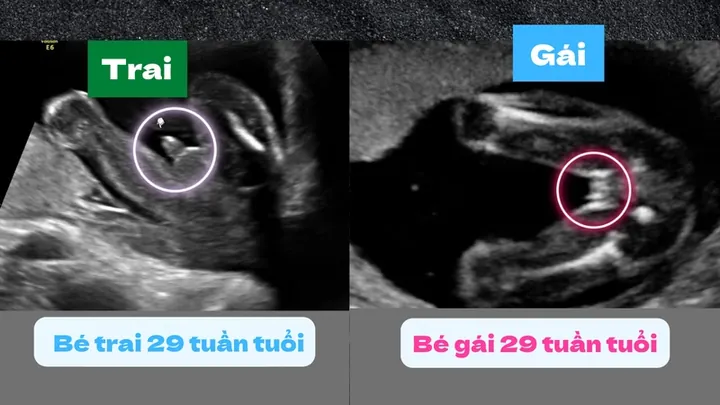 100+ Ảnh Siêu Âm Nhận Biết Trai Gái 4k,100+ Ảnh Dấu Hiệu Trai Gái 100+ Ảnh Siêu Âm Nhận Biết Trai Gái 4k,100+ Ảnh Dấu Hiệu Trai Gái