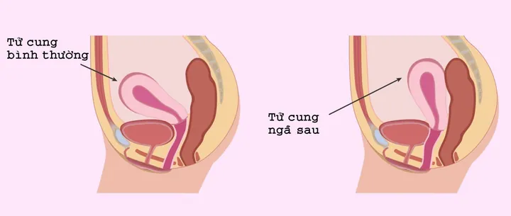 100+ Vung Sau Gáy Có Ảnh Hưởng Đến Mang Thai Hay Nhất 100+ Vung Sau Gáy Có Ảnh Hưởng Đến Mang Thai Hay Nhất