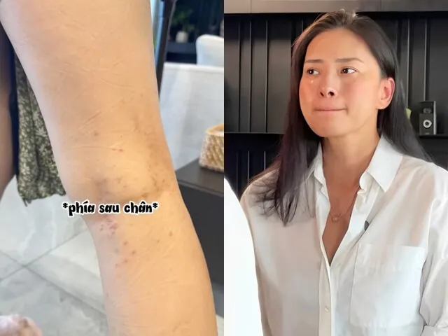 100+ Vung Sau Gáy Có Ảnh Hưởng Đến Mang Thai Hay Nhất 100+ Vung Sau Gáy Có Ảnh Hưởng Đến Mang Thai Hay Nhất