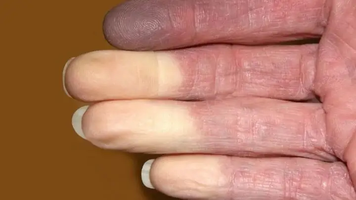 Bệnh Xơ Cứng Là Gì? Phân Loại, Nguyên Nhân Và Cách Nhận Biết Sớm