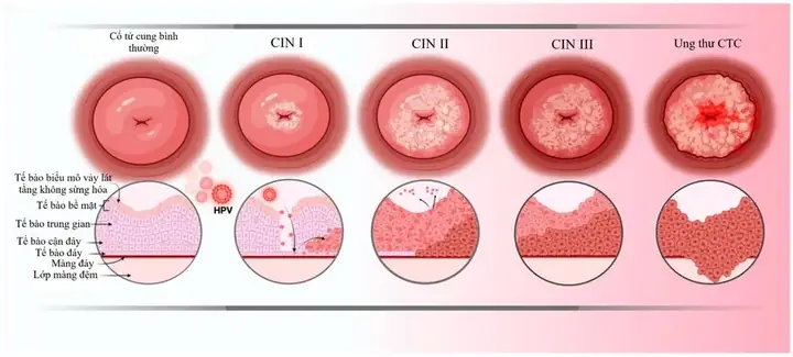 Bệnh Xơ Cứng Là Gì? Phân Loại, Nguyên Nhân Và Cách Nhận Biết Sớm