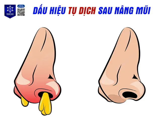 Hút Dịch Mũi Cảm Cúm Ở Đâu Tphcm Uy Tín, An Toàn? Hút Dịch Mũi Cảm Cúm Ở Đâu Tphcm Uy Tín, An Toàn?